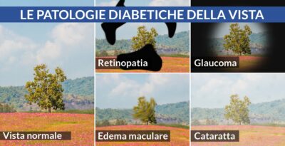 Patologie diabetiche della vista, quali sono