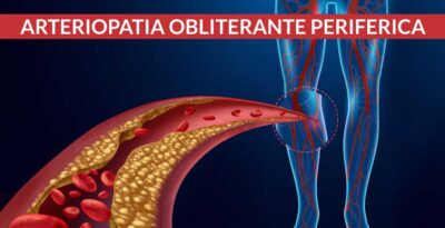 Arteriopatia obliterante periferica