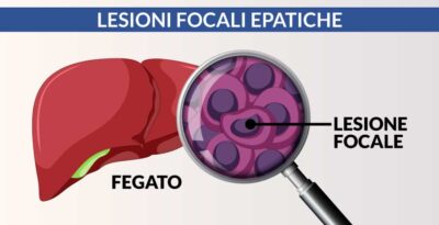 Lesioni focali epatiche benigne e maligne