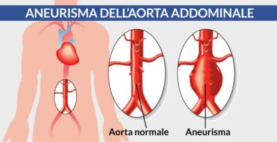 Aneurisma dell’aorta addominale