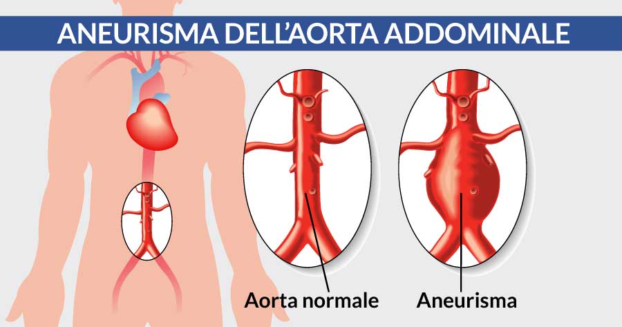 Aneurisma dell'aorta addominale