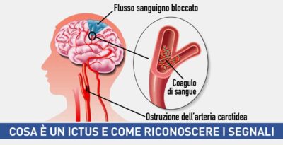 Cosa è un ictus e come riconoscere i segnali