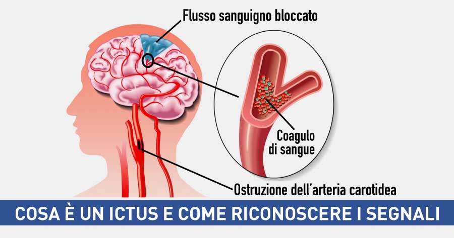 cosa è un ictus e come riconoscere i segnali