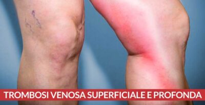 Trombosi venosa superficiale e profonda, differenze