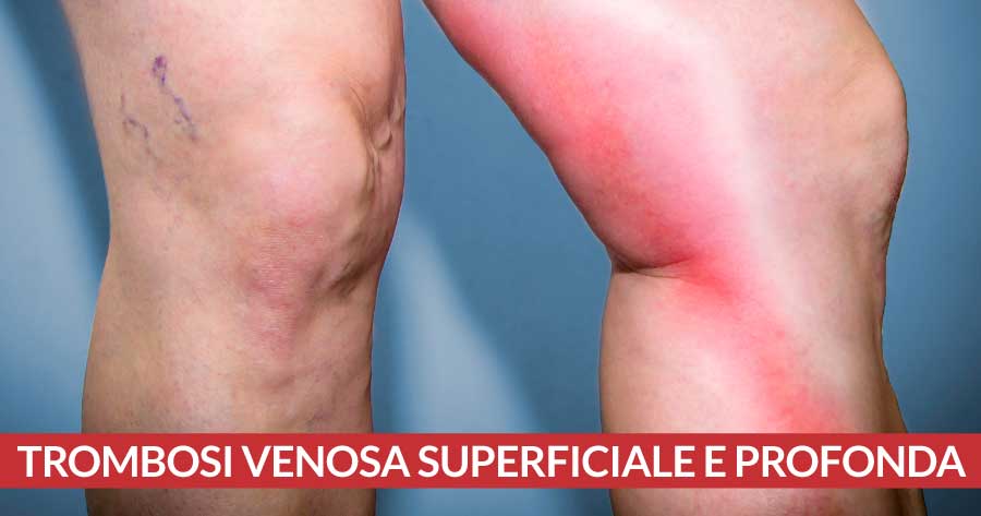 Trombosi-venosa-superficiale-e-profonda-differenze