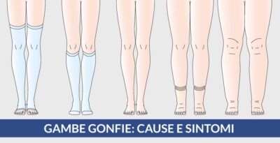 Gambe gonfie, sintomi e cause