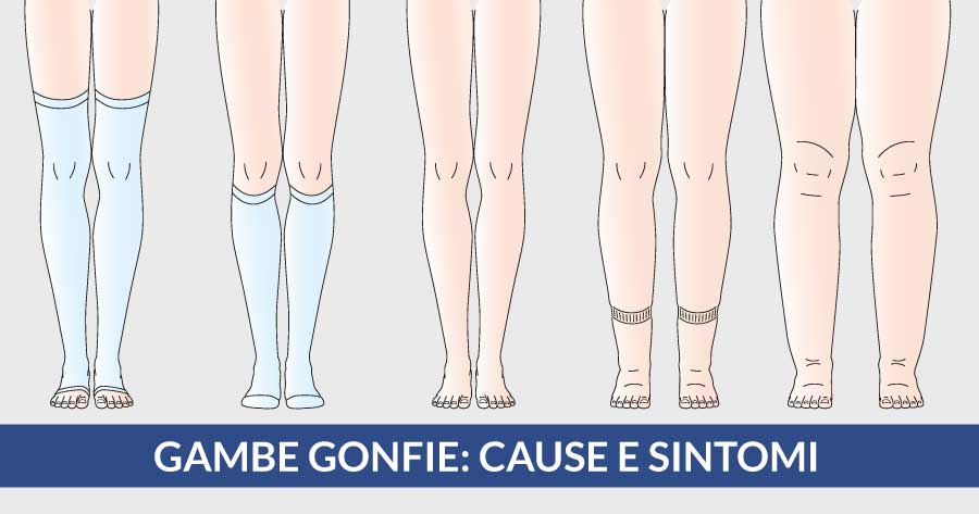 gambe-gonfie-cause-e-sintomi