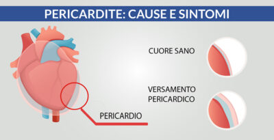 Pericardite: cause e sintomi