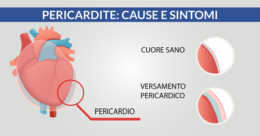 Pericardite: cause e sintomi