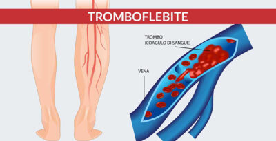 Tromboflebite: cause e sintomi