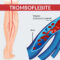 Tromboflebite: cause e sintomi