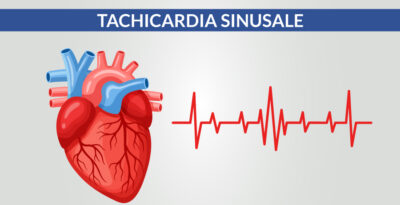 Tachicardia sinusale: cause e sintomi