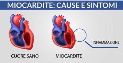 Miocardite: cause e sintomi