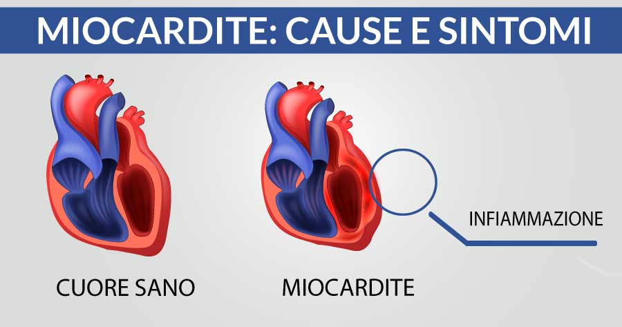 Miocardite-cause-e-sintomi