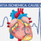 Cardiopatia ischemica: cause e sintomi